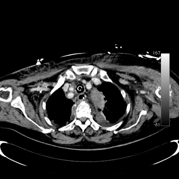 File:Atypical dissection of the thoracic aorta (Radiopaedia 10975-78320 A 3).jpg