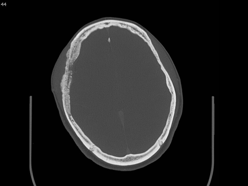 Atypical meningioma - intraosseous (Radiopaedia 64915-73867 Axial C+ bone window 44).jpg