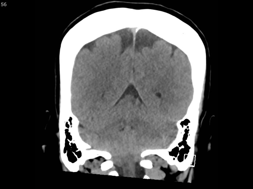 Atypical meningioma - intraosseous (Radiopaedia 64915-73867 B 55).jpg