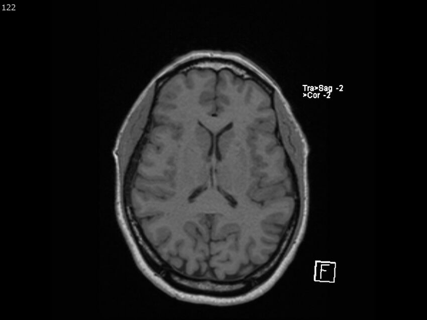 Atypical meningioma - intraosseous (Radiopaedia 64915-74572 Axial T1 122).jpg