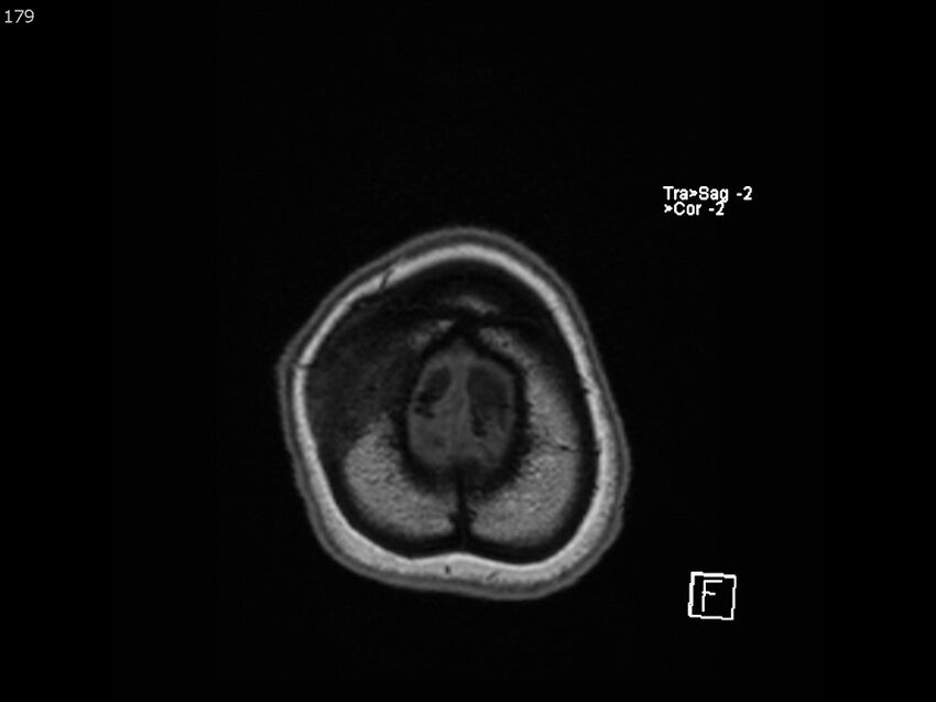 Atypical meningioma - intraosseous (Radiopaedia 64915-74572 Axial T1 179).jpg