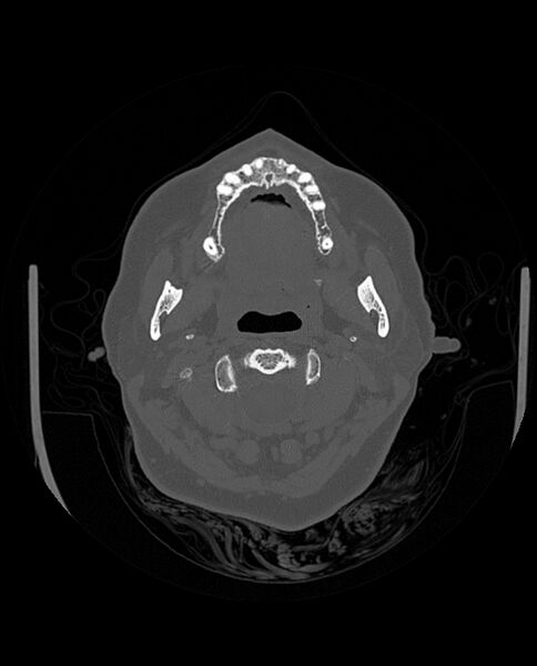 File:Automastoidectomy with labyrinthine fistula (Radiopaedia 84143-99411 Axial non-contrast 27).jpg