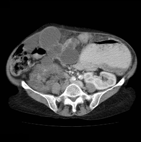 File:Autosomal dominant polycystic kidney disease (Radiopaedia 16777-16490 A 38).jpg