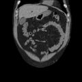 Autosomal dominant polycystic kidney disease (Radiopaedia 36539-38101 C 15).jpg