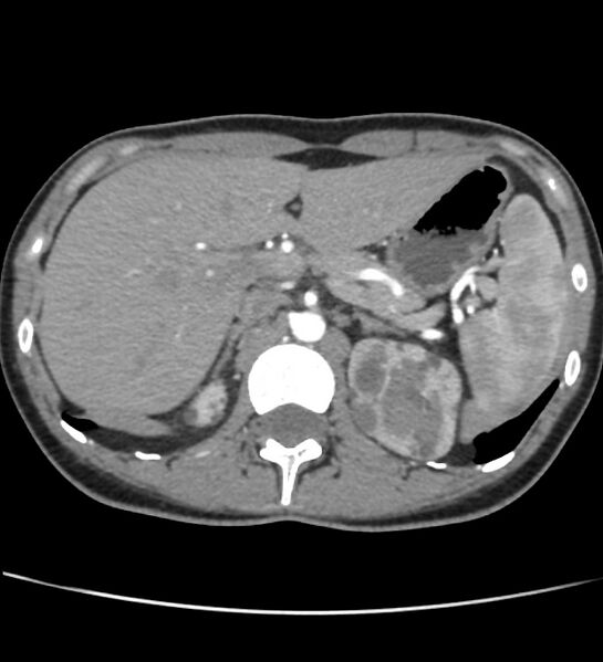 File:Autosomal dominant polycystic kidney disease - early onset (Radiopaedia 40734-43387 B 6).jpg