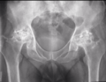 Avascular necrosis - bilateral hip joints (Radiopaedia 27239).PNG
