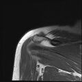 Avulsion fracture - greater tuberosity of humerus (Radiopaedia 71216-81515 Coronal T1 5).jpg