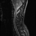 Axis fracture - MRI (Radiopaedia 71925-82375 Sagittal STIR 4).jpg