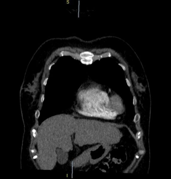 File:Azygos vein aneurysm (Radiopaedia 77824-90130 C 6).JPG