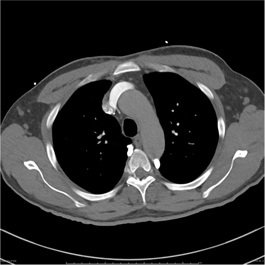 Azygos venous system anatomy (CT pulmonary angiography) (Radiopaedia 25928-26077 Axial C+ CTPA 24).jpg