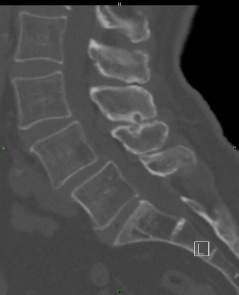 File:Baastrup syndrome (Radiopaedia 48508-53455 Sagittal bone window 1).jpg