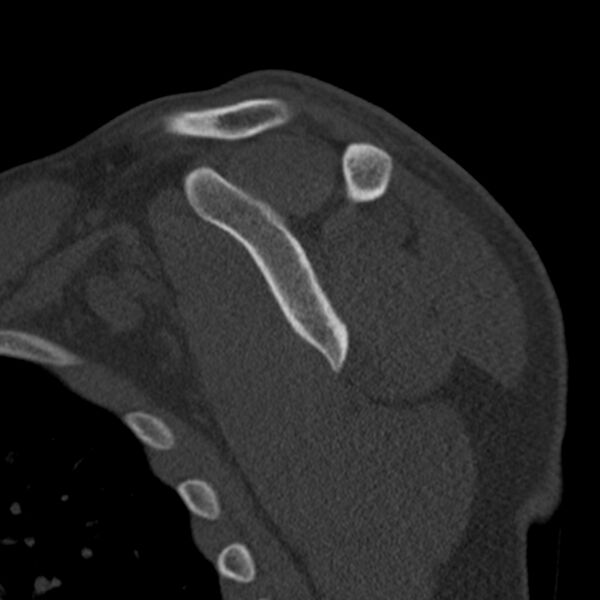 File:Bankart lesion (Radiopaedia 22771-22798 Sagittal bone window 35).jpg