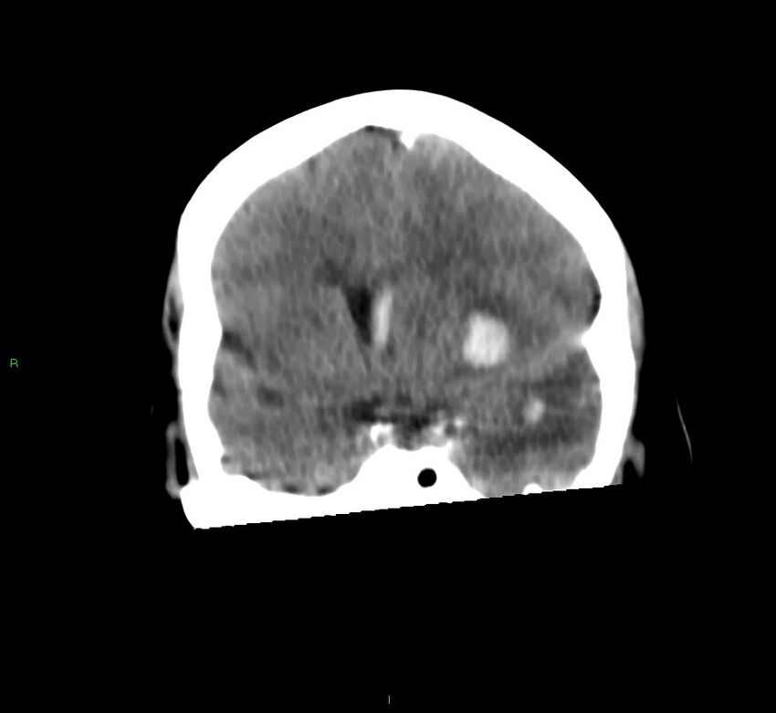 Basal ganglia hemorrhage (Radiopaedia 58759-65981 Coronal non-contrast 45).jpg