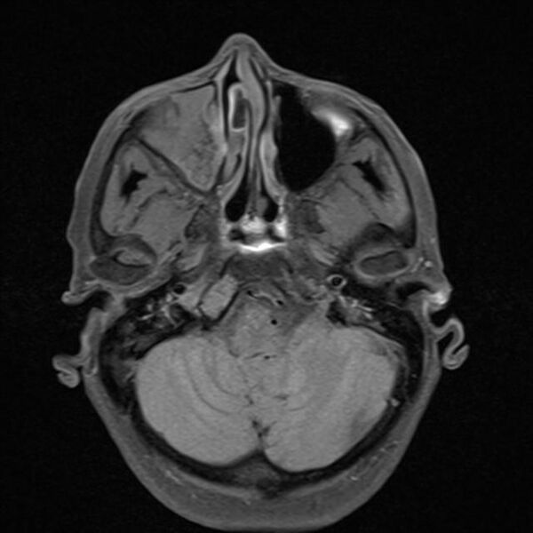 File:Base of skull chondrosarcoma (Radiopaedia 30410-31070 Axial T1 fat sat 6).jpg