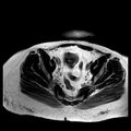 Benign seromucinous cystadenoma of the ovary (Radiopaedia 71065-81300 B 9).jpg