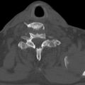 Bilateral C6-7 locked facet dislocation (Radiopaedia 28506-28748 Axial bone window 28).jpeg