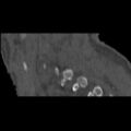 Bilateral C6-7 locked facet dislocation (Radiopaedia 28506-28748 Sagittal bone window 20).jpeg