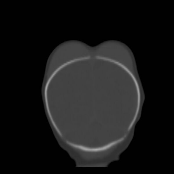 File:Bilateral cephalohematomas and subdural hematomas (Radiopaedia 26778-26929 Coronal bone window 28).jpg