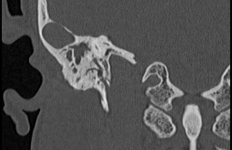 File:Bilateral cholesteatoma (Radiopaedia 54898-61172 Coronal bone window 60).jpg