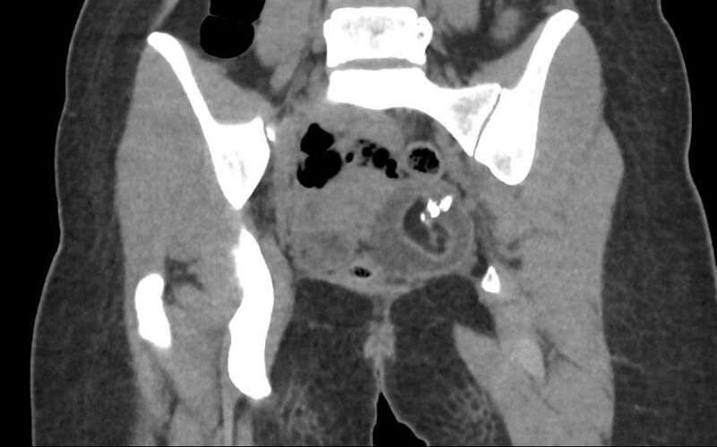 File:Bilateral mature cystic ovarian teratoma (Radiopaedia 88821-105592 Coronal non-contrast 23).jpg