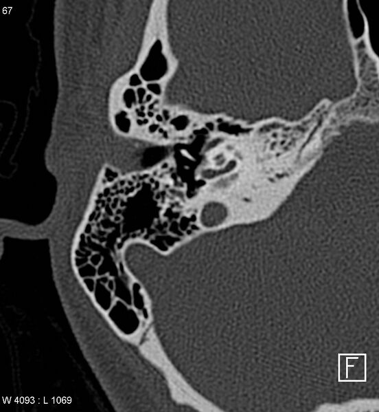 File:Bilateral otosclerosis with left stapes prosthesis (Radiopaedia 5567-7302 Axial bone window 3).jpg