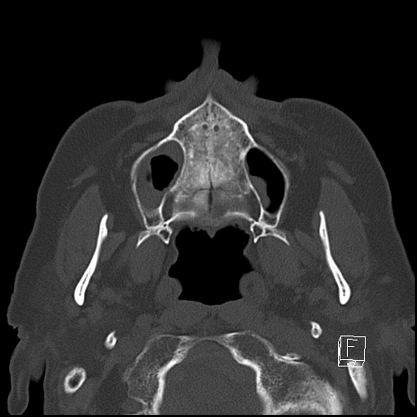 Bilateral palatine tonsilloliths on OPG and CT (Radiopaedia 75167-86247 Axial bone window 29).jpg