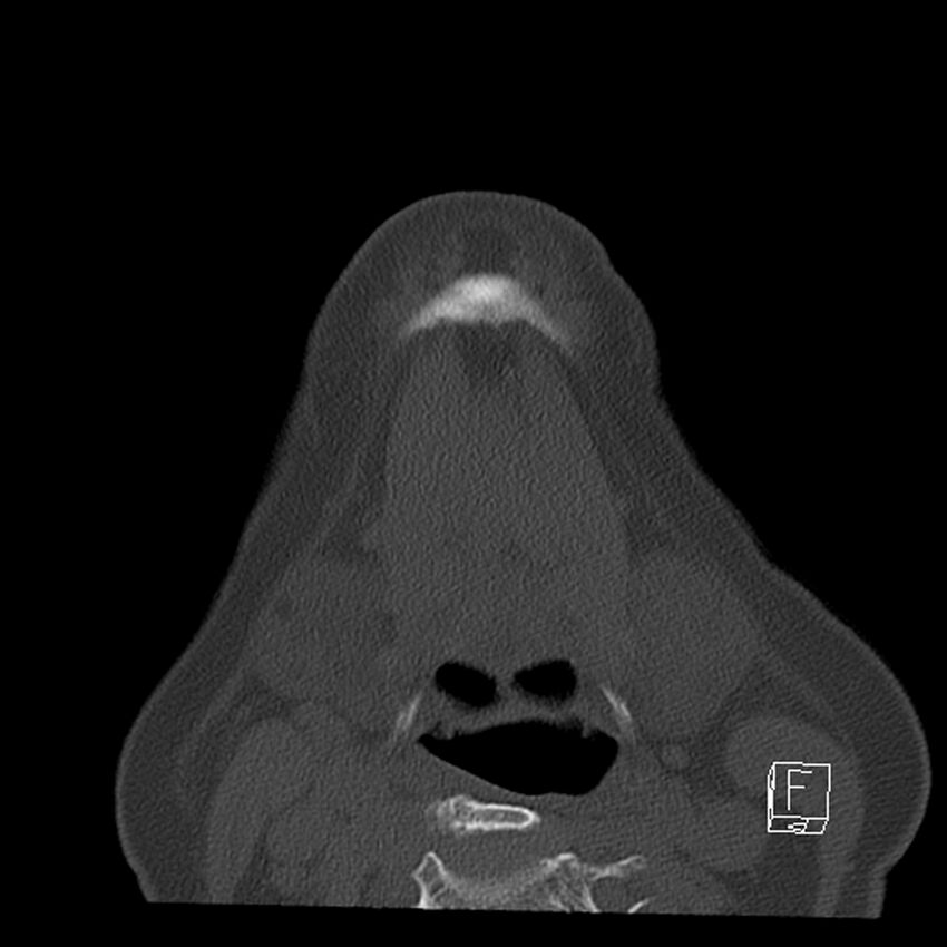 Bilateral palatine tonsilloliths on OPG and CT (Radiopaedia 75167-86247 Axial bone window 59).jpg