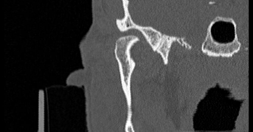 Bilateral temporal bone fractures (Radiopaedia 29482-29970 Coronal non-contrast 41).jpg