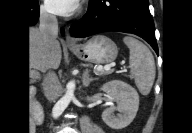 File:Bilateral urolithiasis with incidentally detected splenic artery aneurysm and left inferior vena cava (Radiopaedia 44467-48127 Ob. Cor. C+ Art. 15).jpg