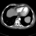 Biliary necrosis - liver transplant (Radiopaedia 21876-21845 A 5).jpg