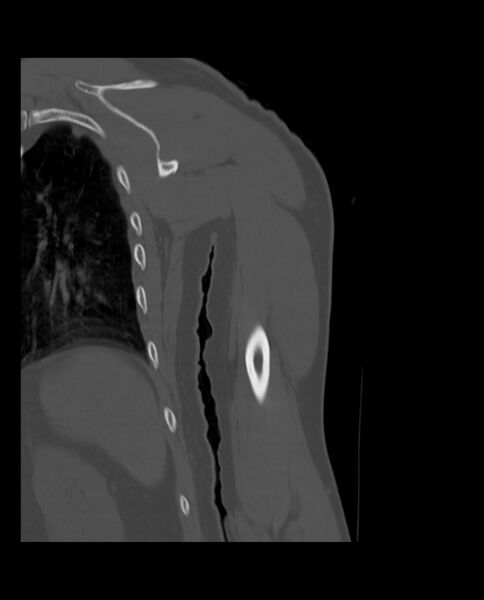 File:Bizarre parosteal osteochondromatous proliferation (Radiopaedia 84221-99501 Coronal bone window 21).jpg