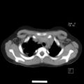 Bochdalek diaphragmatic hernia (Radiopaedia 38866-41059 A 4).jpg