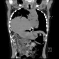 Bochdalek diaphragmatic hernia (Radiopaedia 38866-41059 Coronal liver window 10).jpg