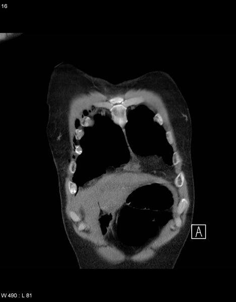 File:Boerhaave syndrome with tension pneumothorax (Radiopaedia 56794-63605 B 3).jpg