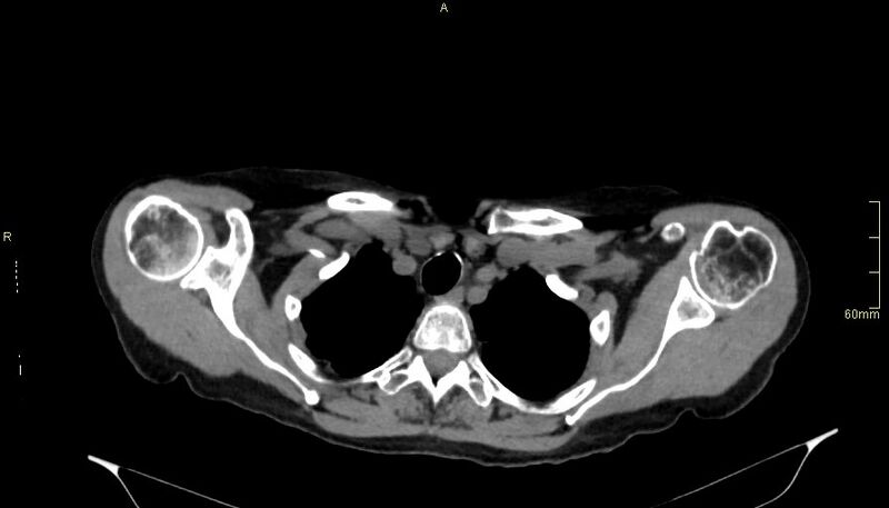 File:Brachial artery foreign body (Radiopaedia 54583-60820 Axial non-contrast 14).jpg