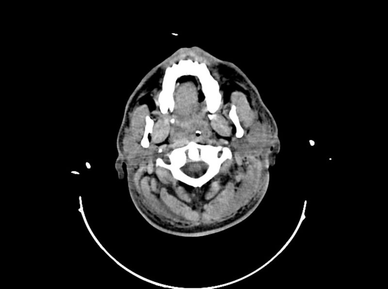 File:Brain injury by firearm projectile (Radiopaedia 82068-96087 B 28).jpg