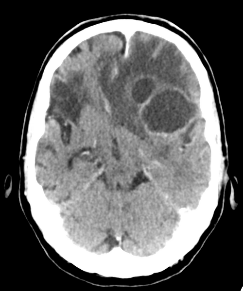 File:Brain metastasis (lung cancer) (Radiopaedia 48289-53177 Axial C+ 11).png
