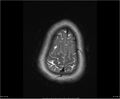 Brainstem glioma (Radiopaedia 21819-21775 Axial T2 35).jpg