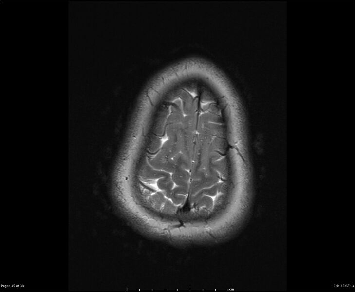File:Brainstem glioma (Radiopaedia 21819-21775 Axial T2 35).jpg