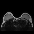 Breast implants - MRI (Radiopaedia 26864-27035 Axial T2 17).jpg