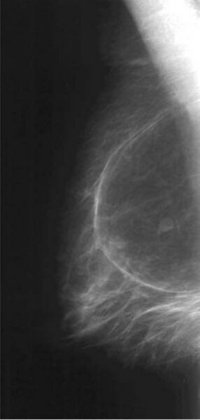 File:Breast lipoma (Radiopaedia 69667-79614 MLO 1).jpg