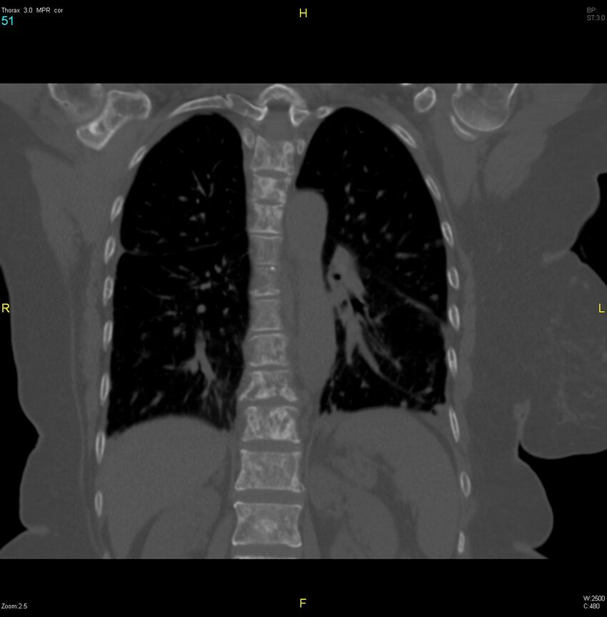 Breast primary with lung and bone metastases (Radiopaedia 40620-43228 bone window 51).jpg