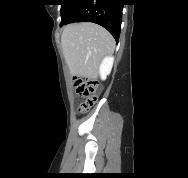 File:Broad ligament hernia (Radiopaedia 63260-71832 C 11).jpg