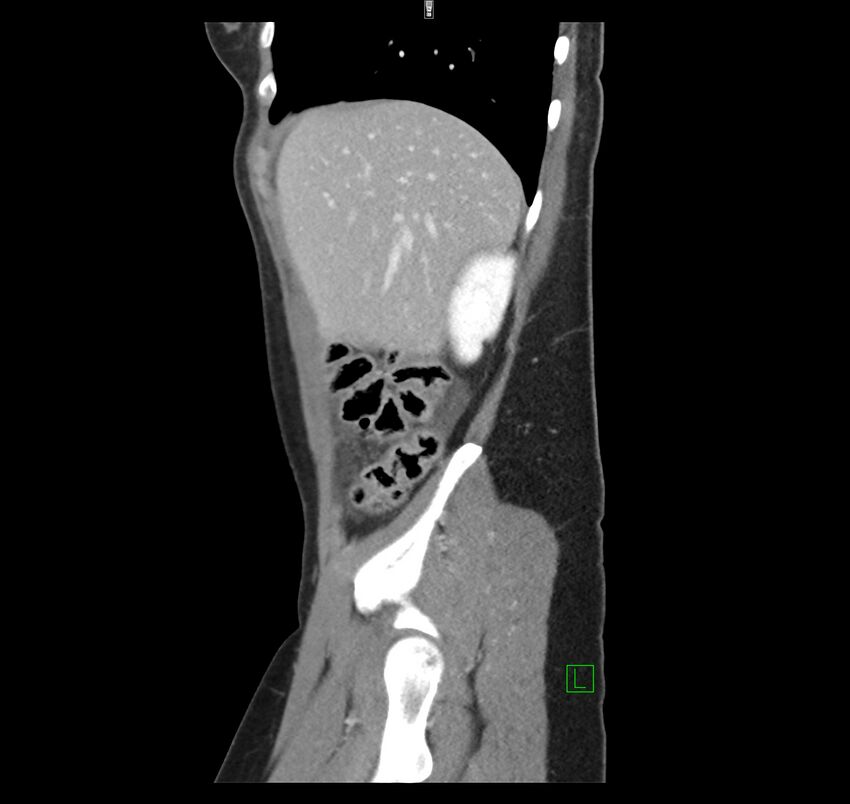 Broad ligament hernia (Radiopaedia 63260-71832 C 11).jpg