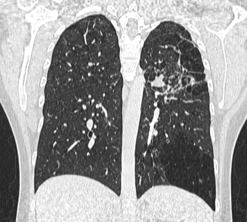 Bronchial atresia (Radiopaedia 50007-55297 Coronal lung window 75).jpg
