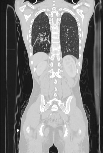 File:Bronchial carcinoid tumor (Radiopaedia 57187-64090 Coronal lung window 89).jpg