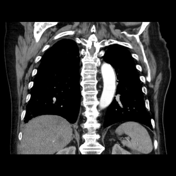 File:Bronchogenic adenocarcinoma and pulmonary embolism (Radiopaedia 9097-9806 C 36).jpg