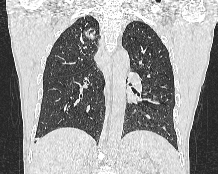 Bronchogenic carcinoma with superior vena cava syndrome (Radiopaedia 36497-38054 Coronal lung window 64).jpg