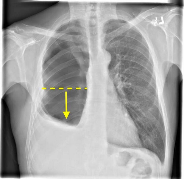 File:Bronchopleural fistula (Radiopaedia 11262-49081 Frontal chest radiograph 1).jpg