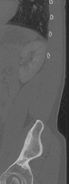 File:Burst fracture - T12 with conus compression (Radiopaedia 56825-63647 Sagittal bone window 6).png